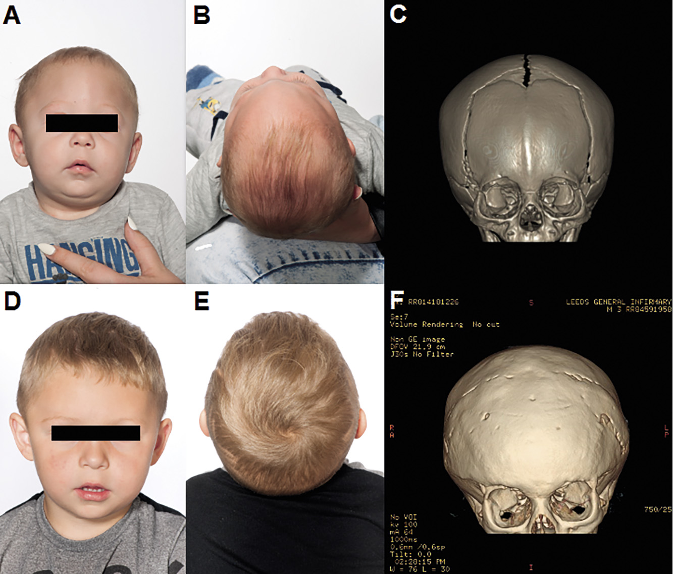 Craniosynostosis | ACNR Journal